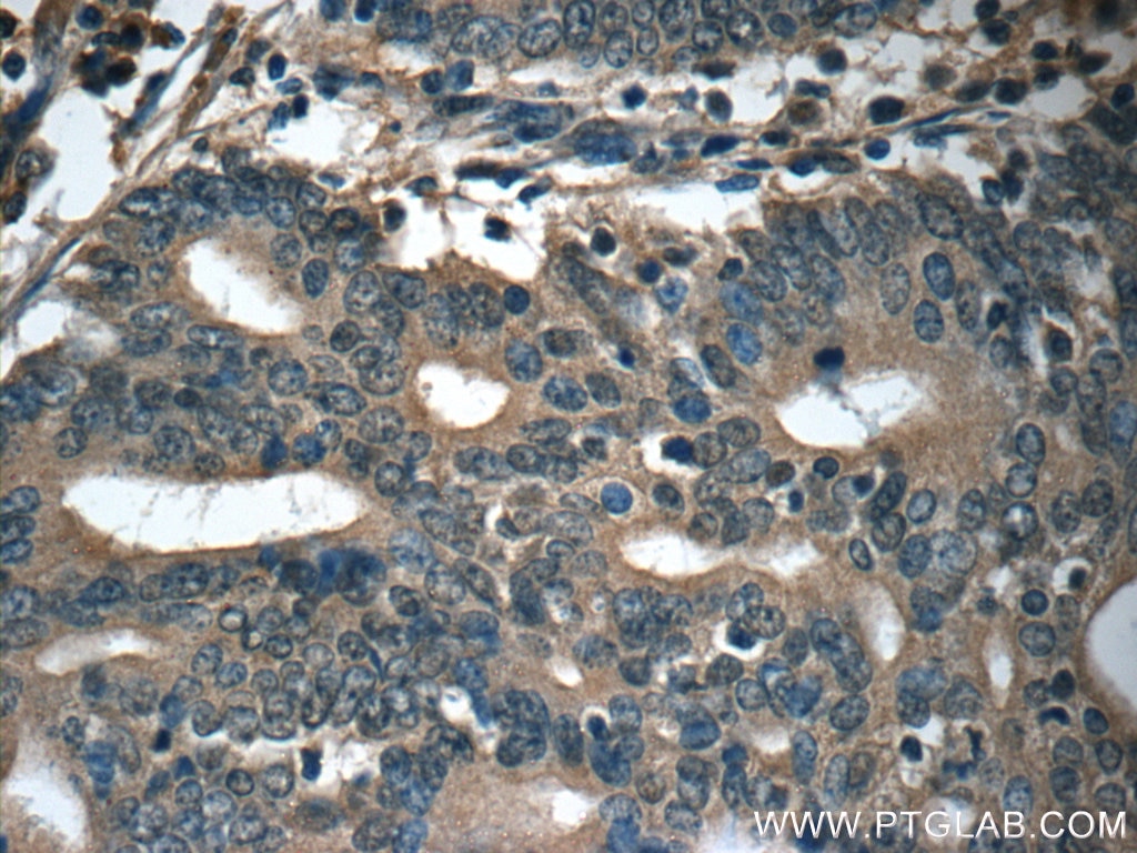 IHC staining of human endometrial cancer using 13615-1-AP