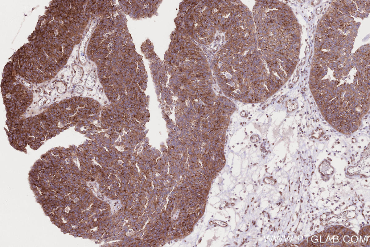 Immunohistochemistry (IHC) staining of human ovary cancer tissue using IFT20 Polyclonal antibody (13615-1-AP)