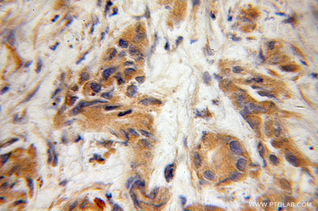 Immunohistochemistry (IHC) staining of human prostate cancer tissue using IFT57 Polyclonal antibody (11083-1-AP)