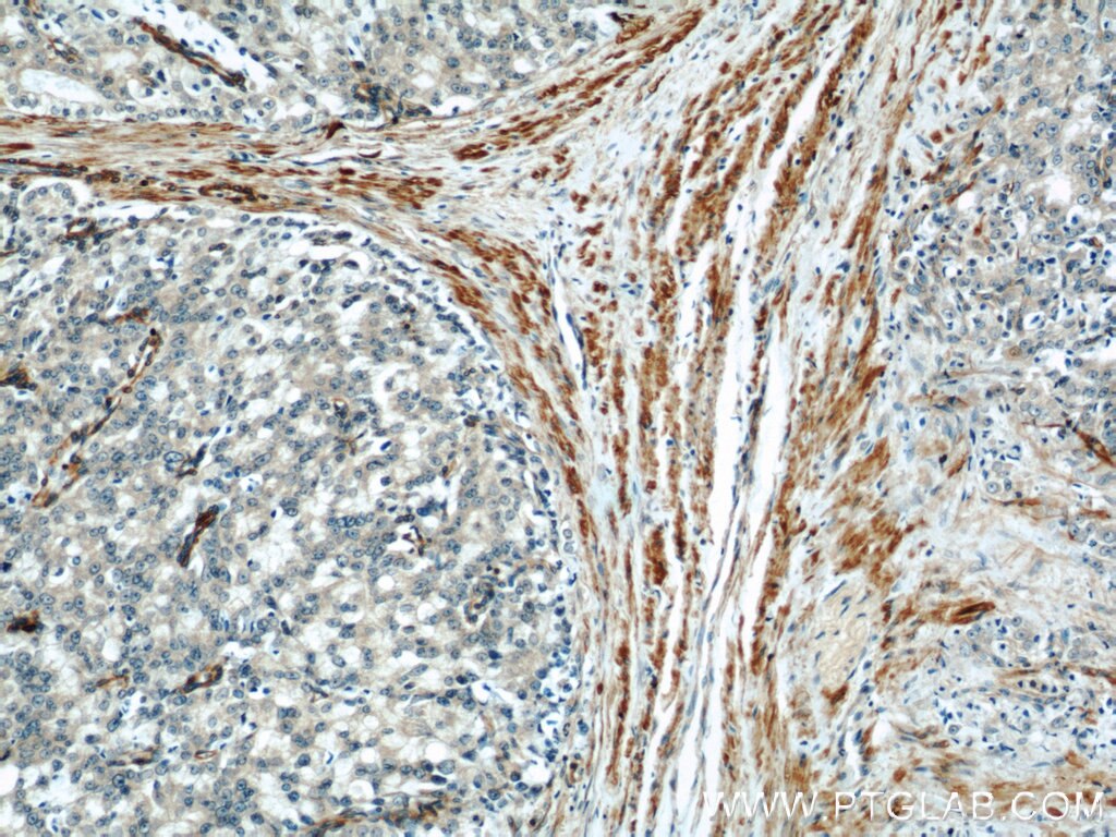 Immunohistochemistry (IHC) staining of human prostate cancer tissue using IFT57 Polyclonal antibody (11083-1-AP)