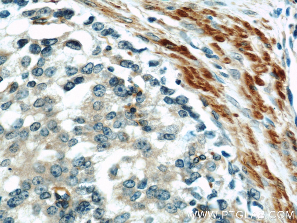 Immunohistochemistry (IHC) staining of human prostate cancer tissue using IFT57 Polyclonal antibody (11083-1-AP)