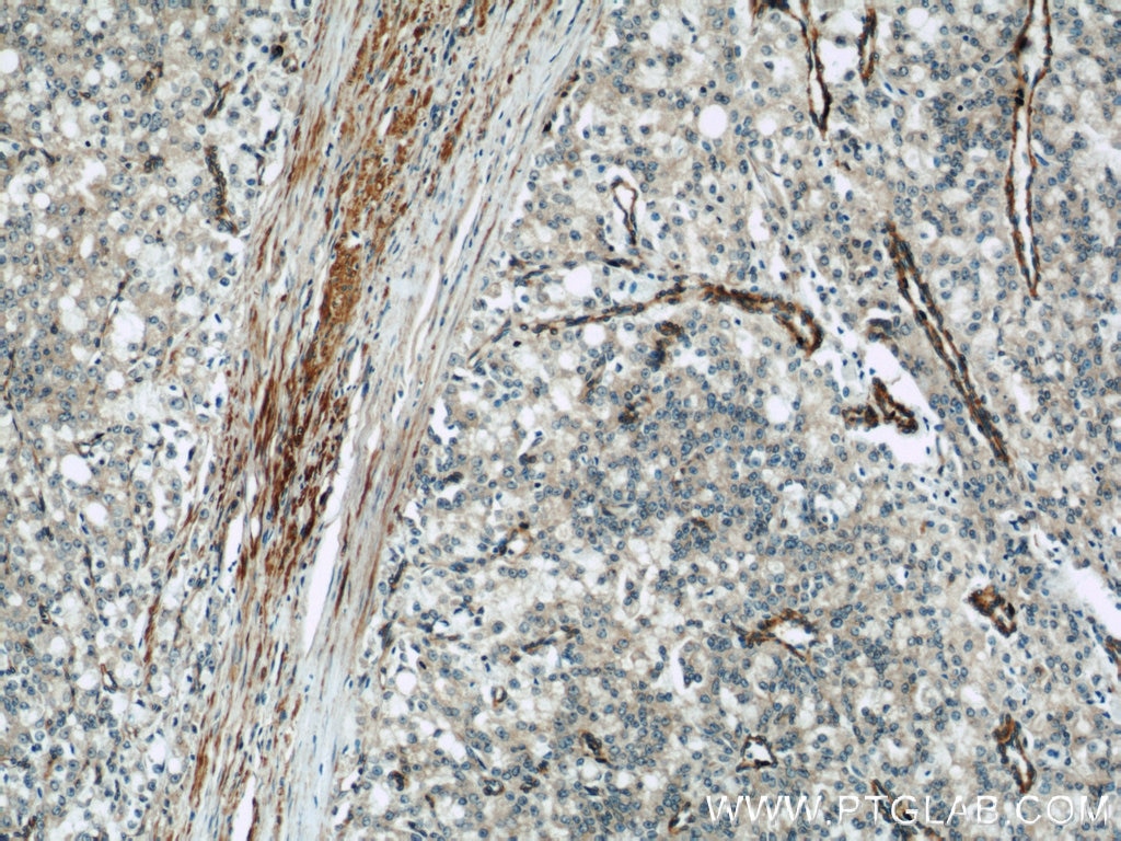 Immunohistochemistry (IHC) staining of human prostate cancer tissue using IFT57 Polyclonal antibody (11083-1-AP)