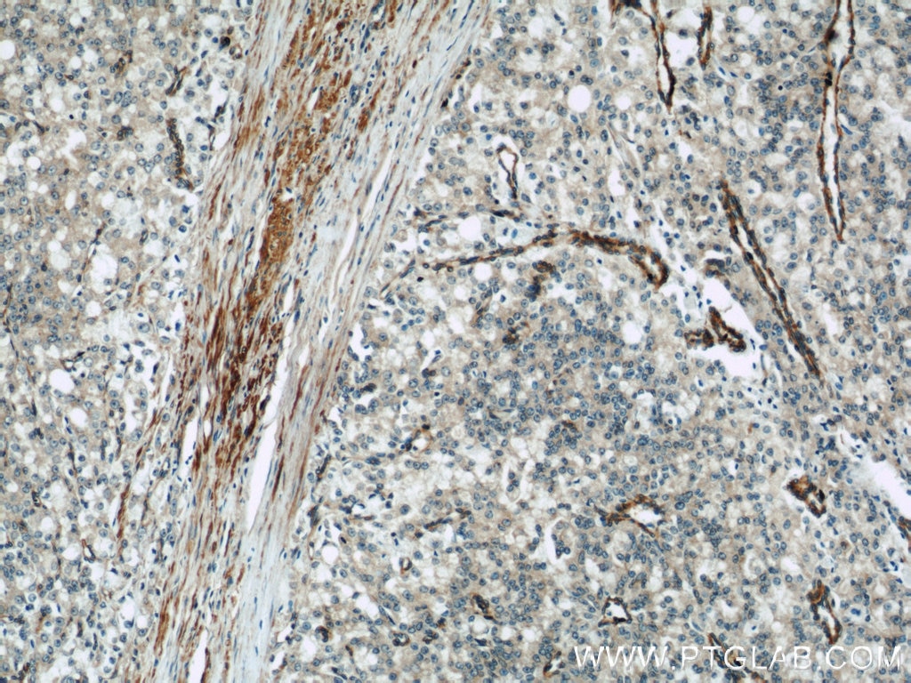 IHC staining of human prostate cancer using 11083-1-AP