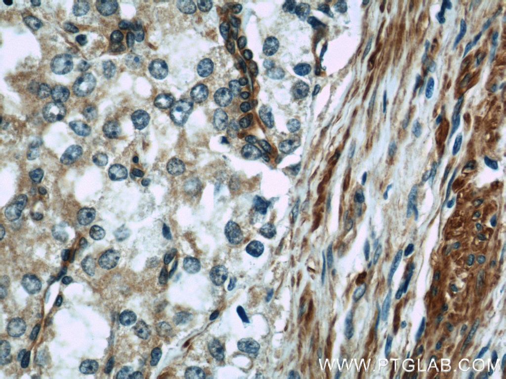 Immunohistochemistry (IHC) staining of human prostate cancer tissue using IFT57 Polyclonal antibody (11083-1-AP)