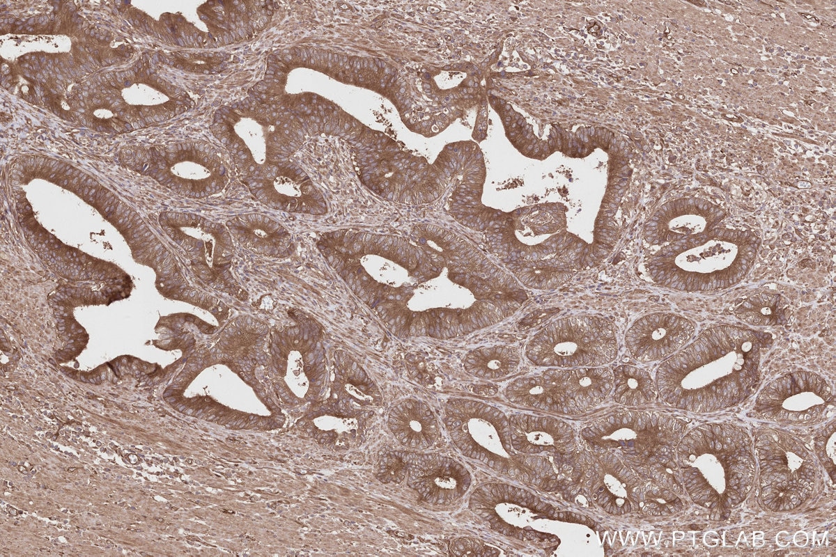 IHC staining of human rectal cancer using 27334-1-AP Immunohistochemistry (IHC) staining of human rectal cancer tissue using IFT74 Polyclonal antibody (27334-1-AP)