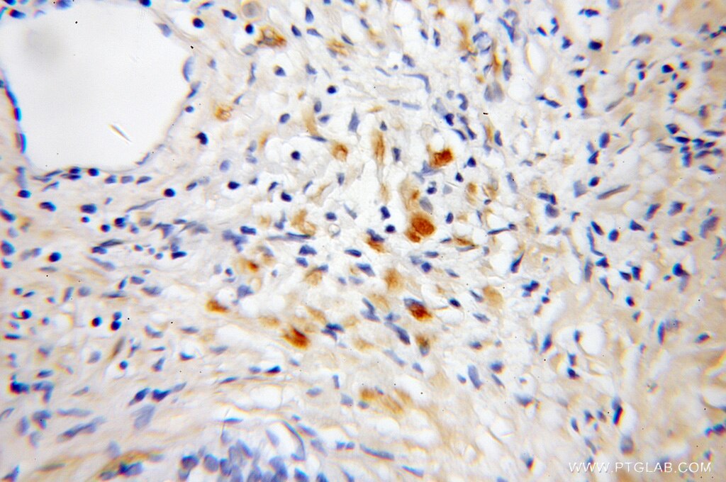 Immunohistochemistry (IHC) staining of human prostate cancer tissue using IFT81 Polyclonal antibody (11744-1-AP)