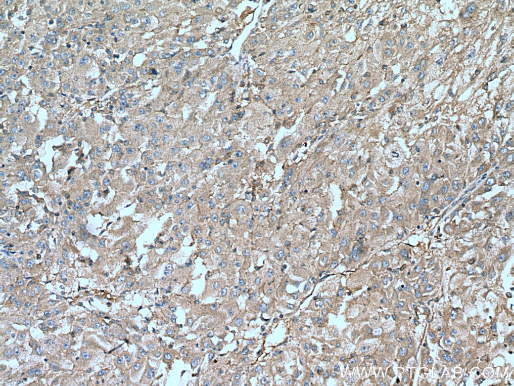 Immunohistochemistry (IHC) staining of human liver cancer tissue using IGF1A-Specific Polyclonal antibody (20214-1-AP)