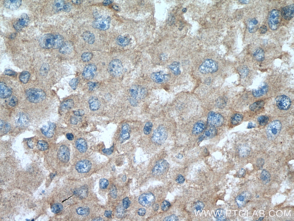 Immunohistochemistry (IHC) staining of human liver cancer tissue using IGF1A-Specific Polyclonal antibody (20214-1-AP)