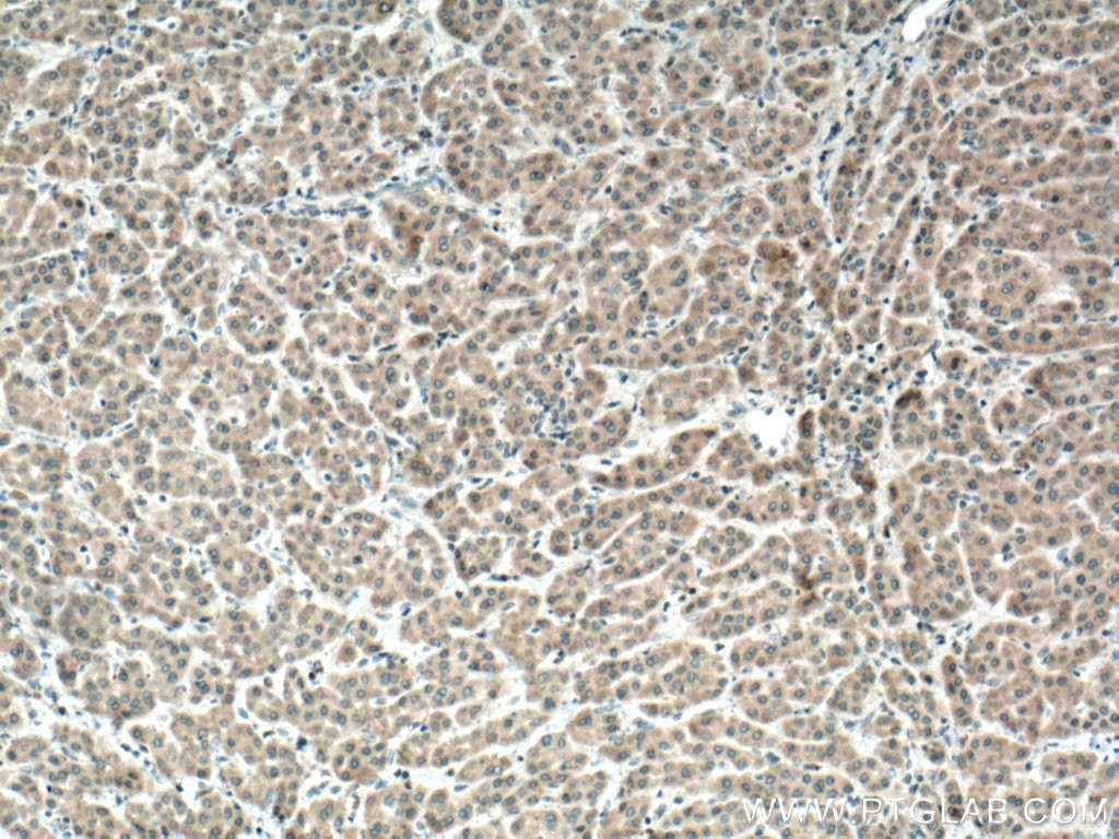IHC staining of human liver cancer using 20215-1-AP