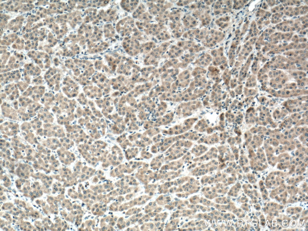 Immunohistochemistry (IHC) staining of human liver cancer tissue using IGF1B-Specific Polyclonal antibody (20215-1-AP)