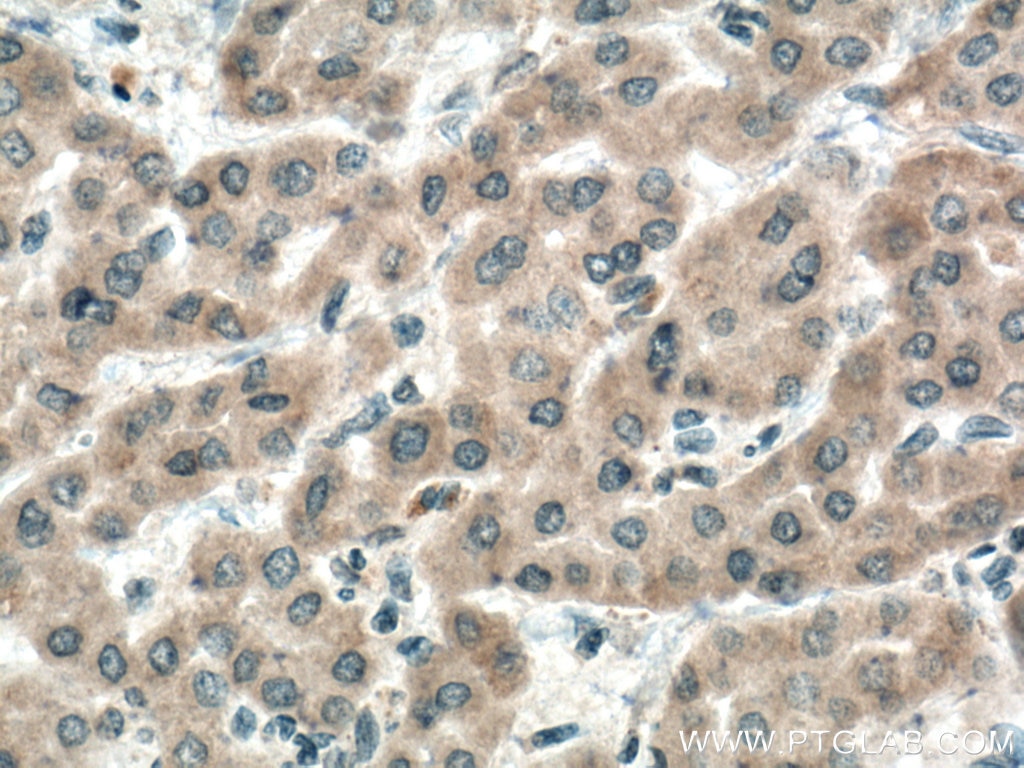 Immunohistochemistry (IHC) staining of human liver cancer tissue using IGF1B-Specific Polyclonal antibody (20215-1-AP)