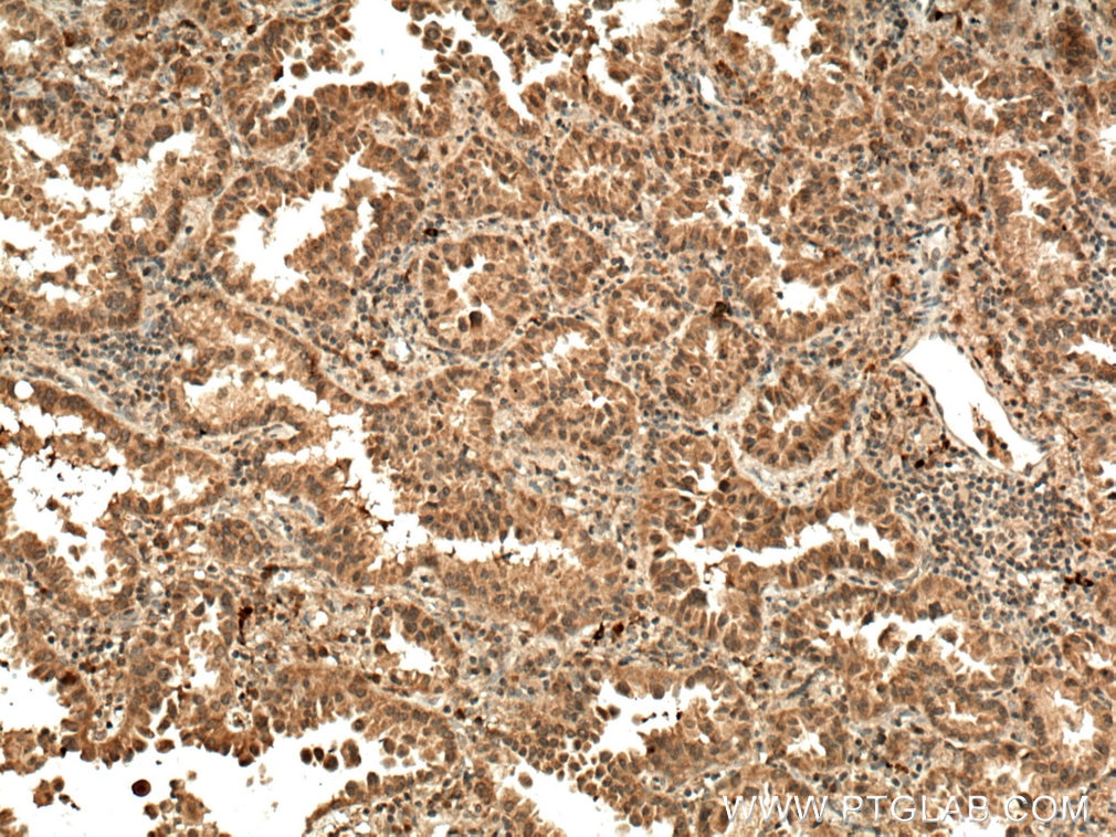 Immunohistochemistry (IHC) staining of human lung cancer tissue using IGF1B-Specific Polyclonal antibody (20215-1-AP)