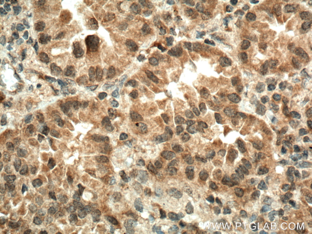 Immunohistochemistry (IHC) staining of human lung cancer tissue using IGF1B-Specific Polyclonal antibody (20215-1-AP)