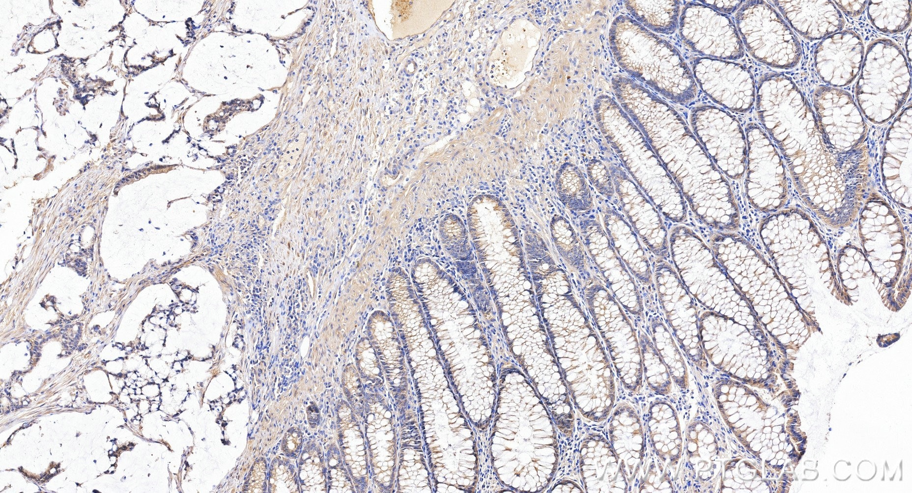 Immunohistochemistry (IHC) staining of human colon cancer tissue using IGF1R/CD221 Recombinant monoclonal antibody (84385-3-RR)