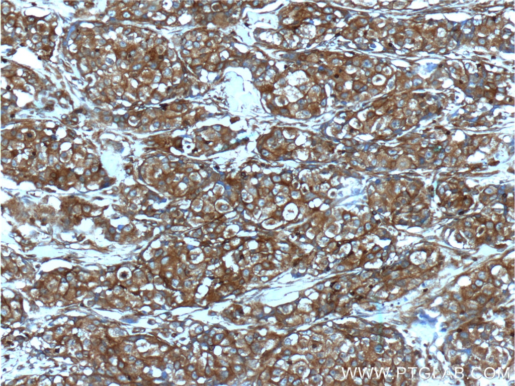 IHC staining of human lung cancer using 20254-1-AP