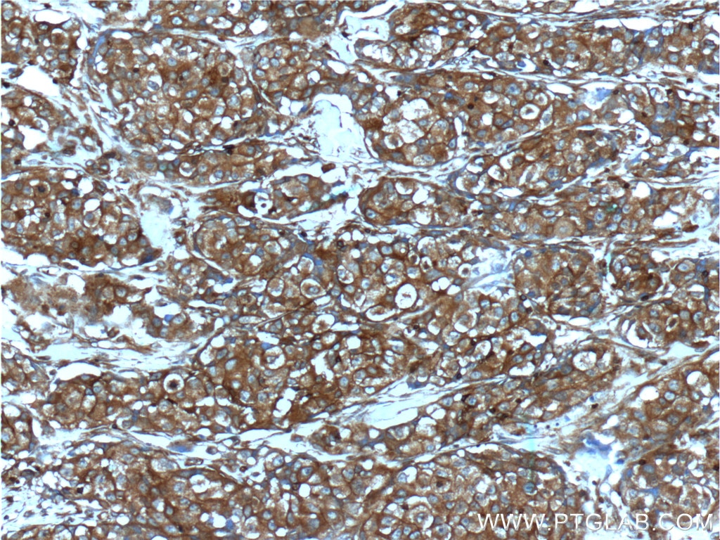 Immunohistochemistry (IHC) staining of human lung cancer tissue using IGF1R Beta Chain Polyclonal antibody (20254-1-AP)