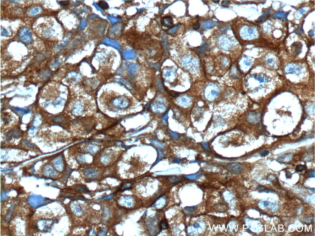 Immunohistochemistry (IHC) staining of human lung cancer tissue using IGF1R Beta Chain Polyclonal antibody (20254-1-AP)
