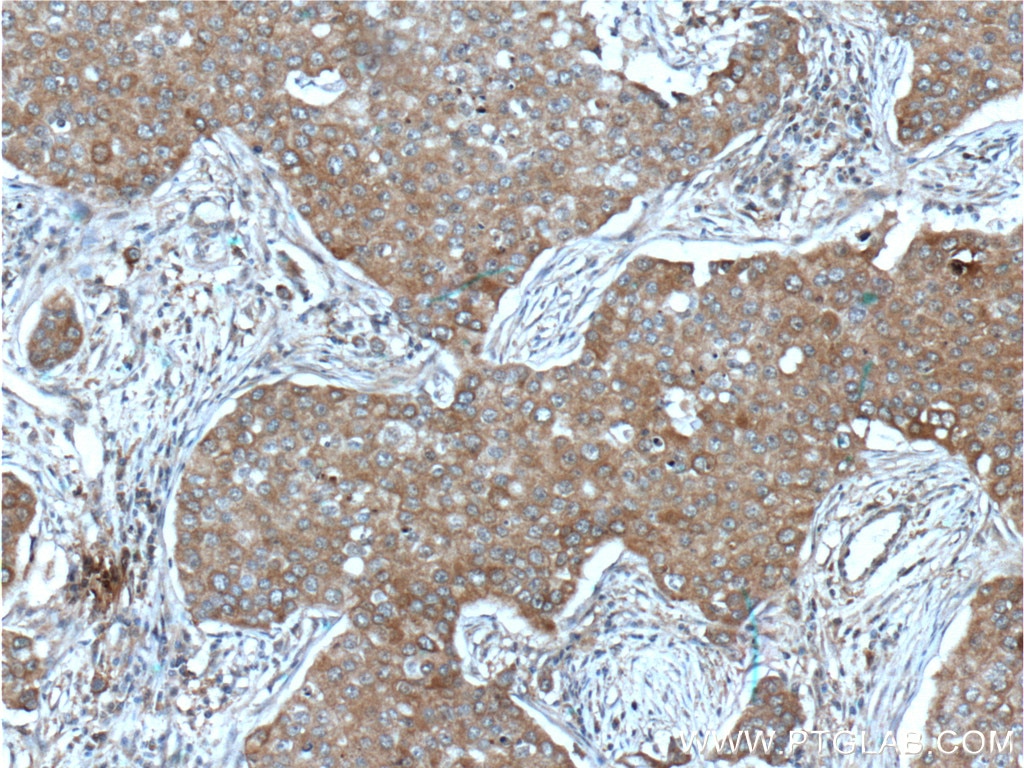 Immunohistochemistry (IHC) staining of human breast cancer tissue using IGF1R Beta Chain Monoclonal antibody (66283-1-Ig)