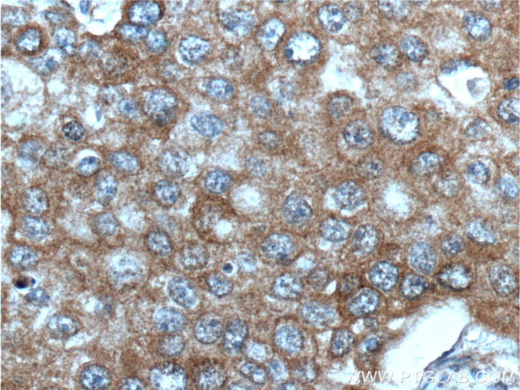Immunohistochemistry (IHC) staining of human breast cancer tissue using IGF1R Beta Chain Monoclonal antibody (66283-1-Ig)