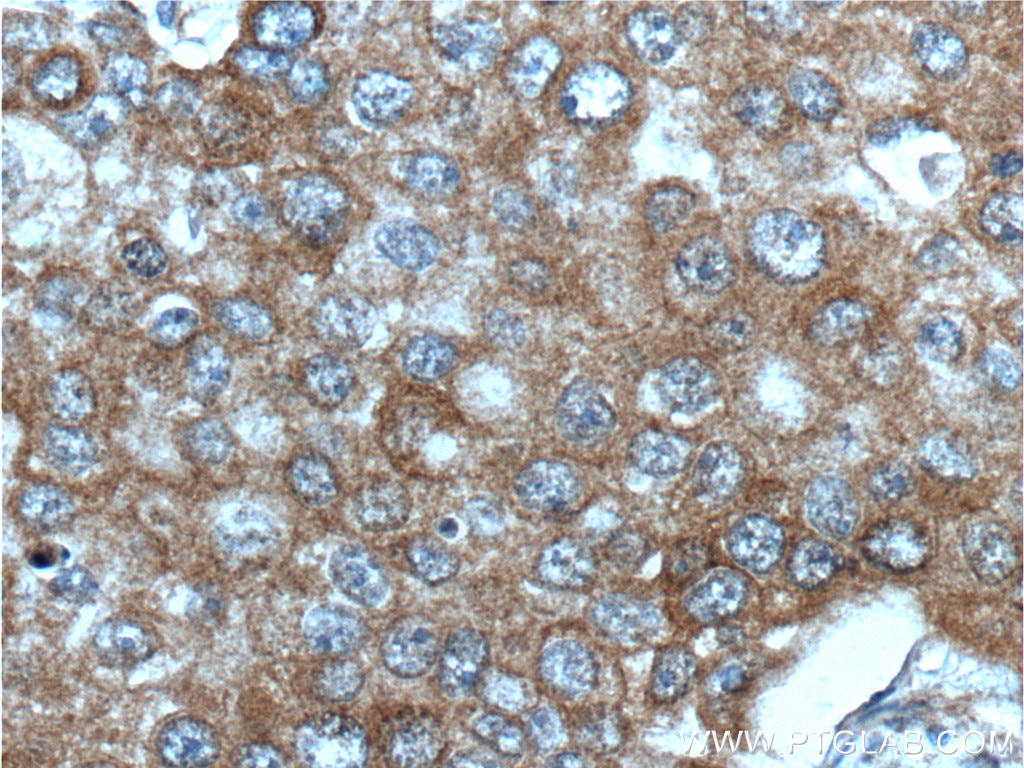 IHC staining of human breast cancer using 66283-1-Ig