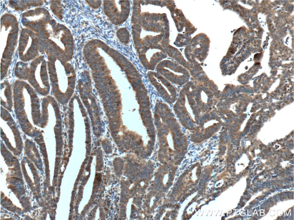 Immunohistochemistry (IHC) staining of human endometrial cancer tissue using IGF1R Beta Chain Monoclonal antibody (66283-1-Ig)