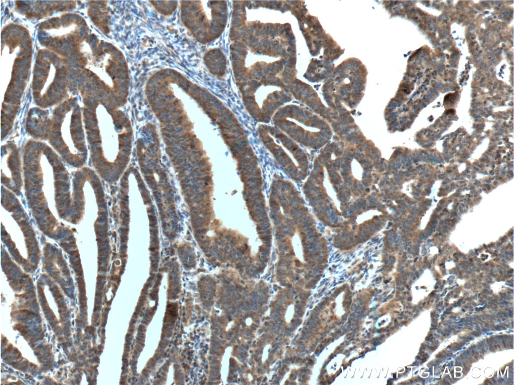 IHC staining of human endometrial cancer using 66283-1-Ig