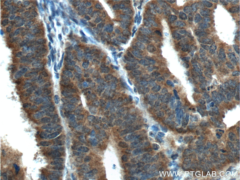 IHC staining of human endometrial cancer using 66283-1-Ig