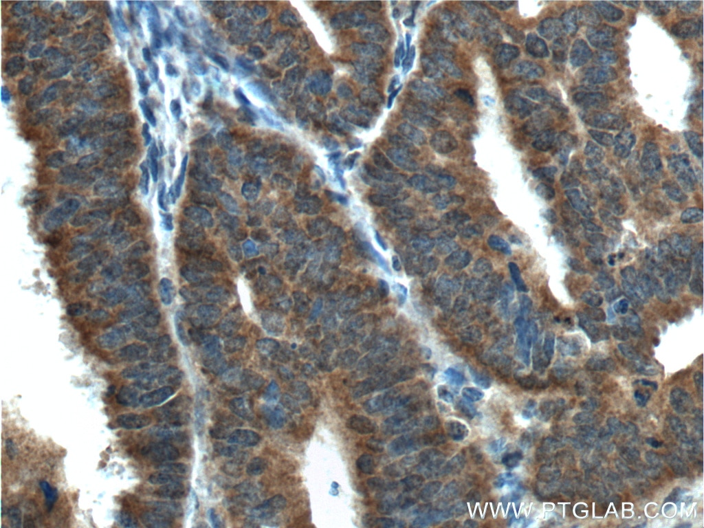 Immunohistochemistry (IHC) staining of human endometrial cancer tissue using IGF1R Beta Chain Monoclonal antibody (66283-1-Ig)