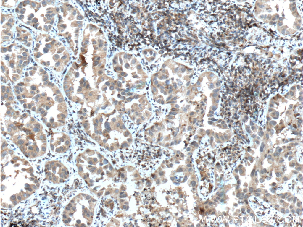 Immunohistochemistry (IHC) staining of human lung cancer tissue using IGF1R Beta Chain Monoclonal antibody (66283-1-Ig)