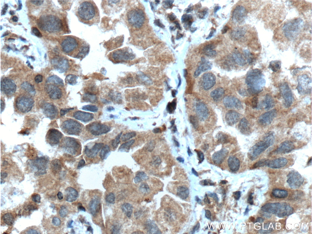 IHC staining of human lung cancer using 66283-1-Ig