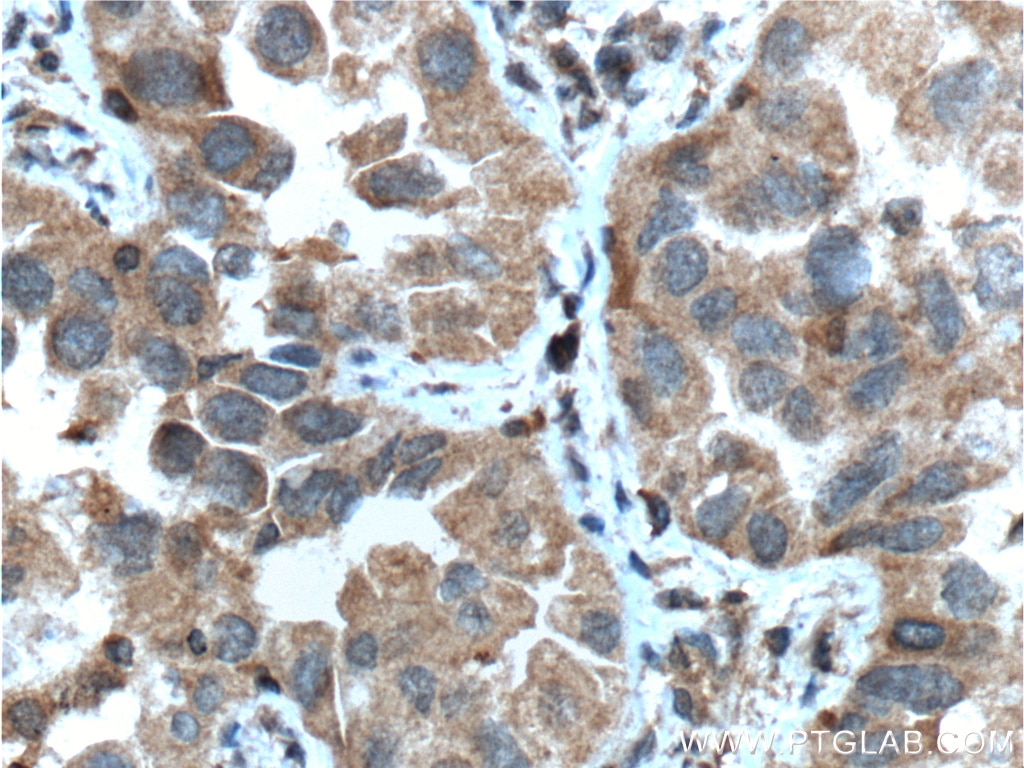 Immunohistochemistry (IHC) staining of human lung cancer tissue using IGF1R Beta Chain Monoclonal antibody (66283-1-Ig)