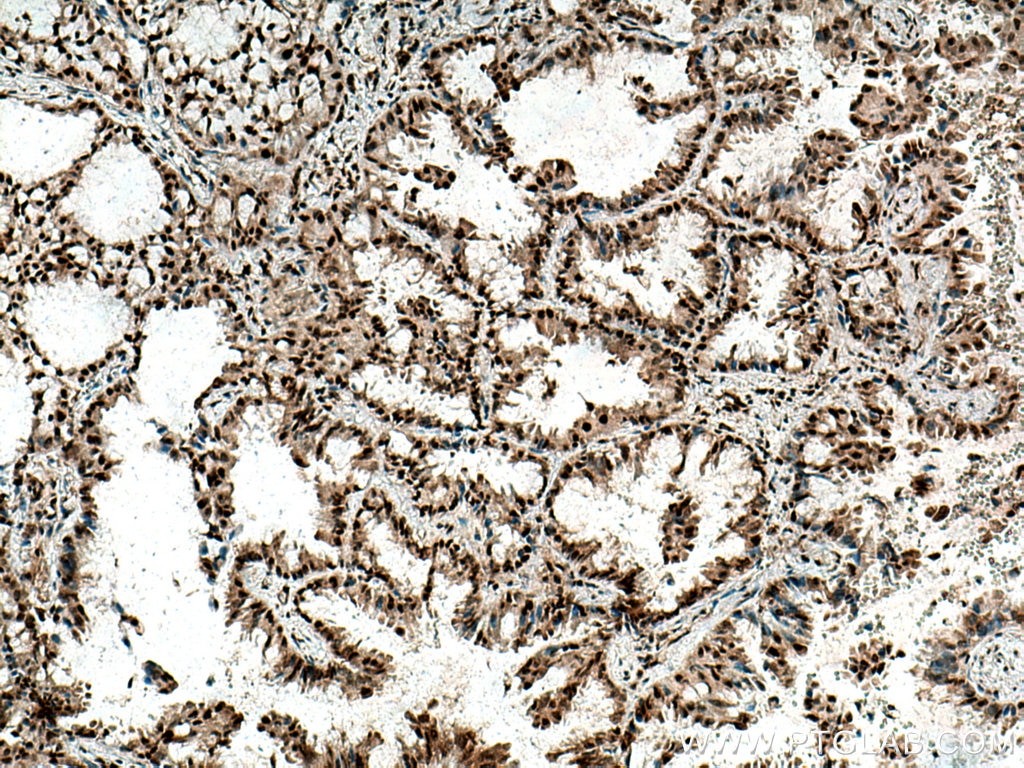 Immunohistochemistry (IHC) staining of human lung cancer tissue using IGF2BP1 Polyclonal antibody (22803-1-AP)
