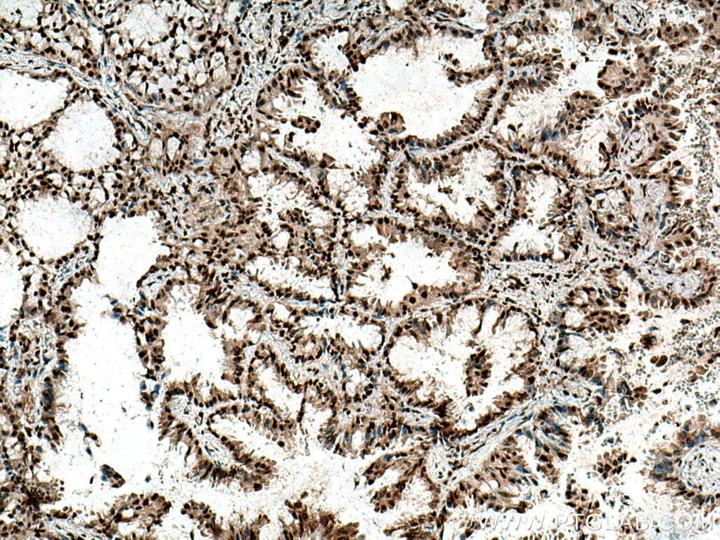 IHC staining of human lung cancer using 22803-1-AP