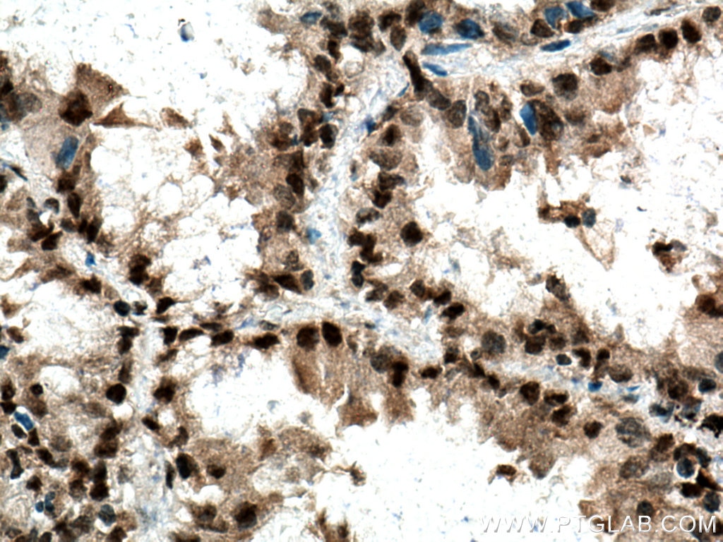 Immunohistochemistry (IHC) staining of human lung cancer tissue using IGF2BP1 Polyclonal antibody (22803-1-AP)