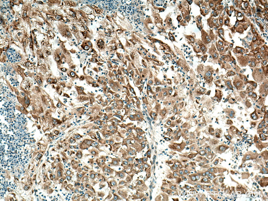 Immunohistochemistry (IHC) staining of human liver cancer tissue using IGF2BP1 Polyclonal antibody (22803-1-AP)