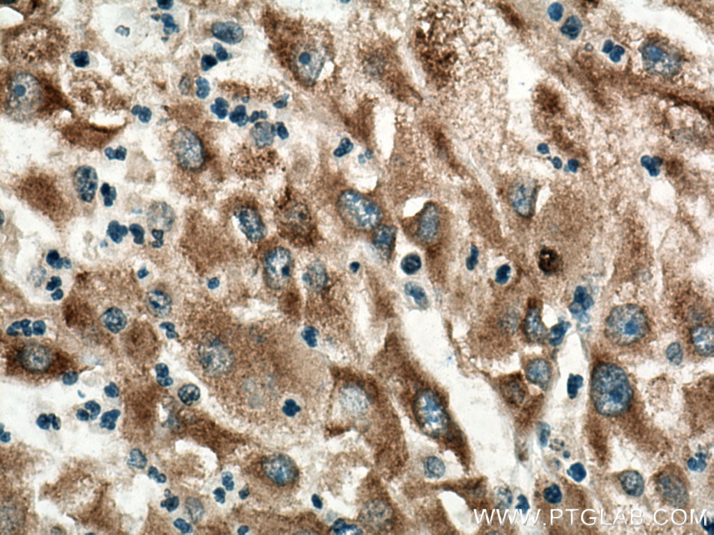 Immunohistochemistry (IHC) staining of human liver cancer tissue using IGF2BP1 Polyclonal antibody (22803-1-AP)