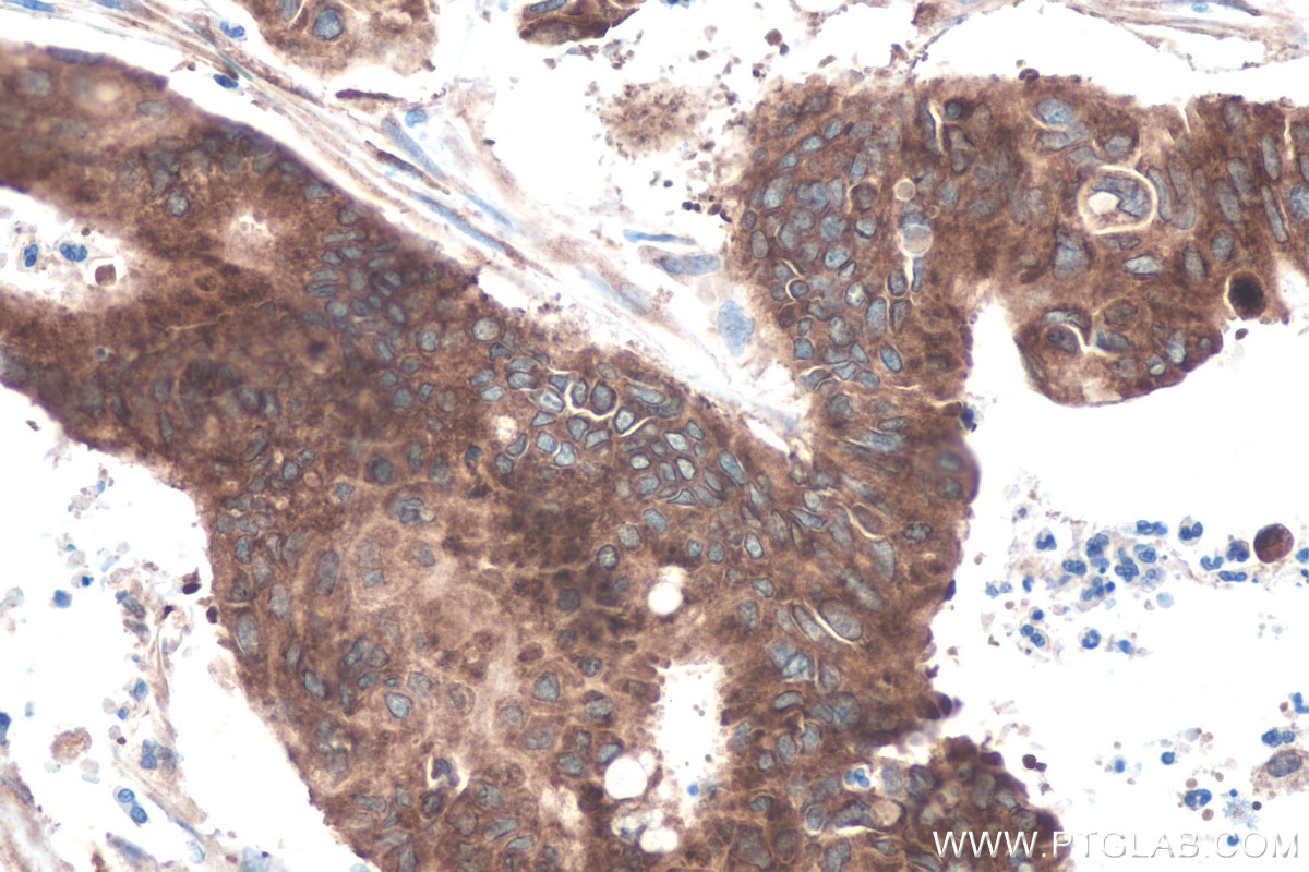 Immunohistochemistry (IHC) staining of human colon cancer tissue using IGF2BP2 Polyclonal antibody (11601-1-AP)