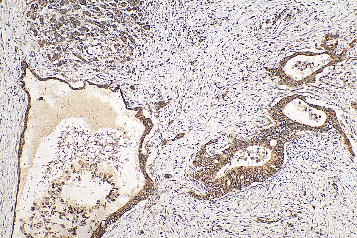 Immunohistochemistry (IHC) staining of human pancreas cancer tissue using IGF2BP2 Polyclonal antibody (11601-1-AP)