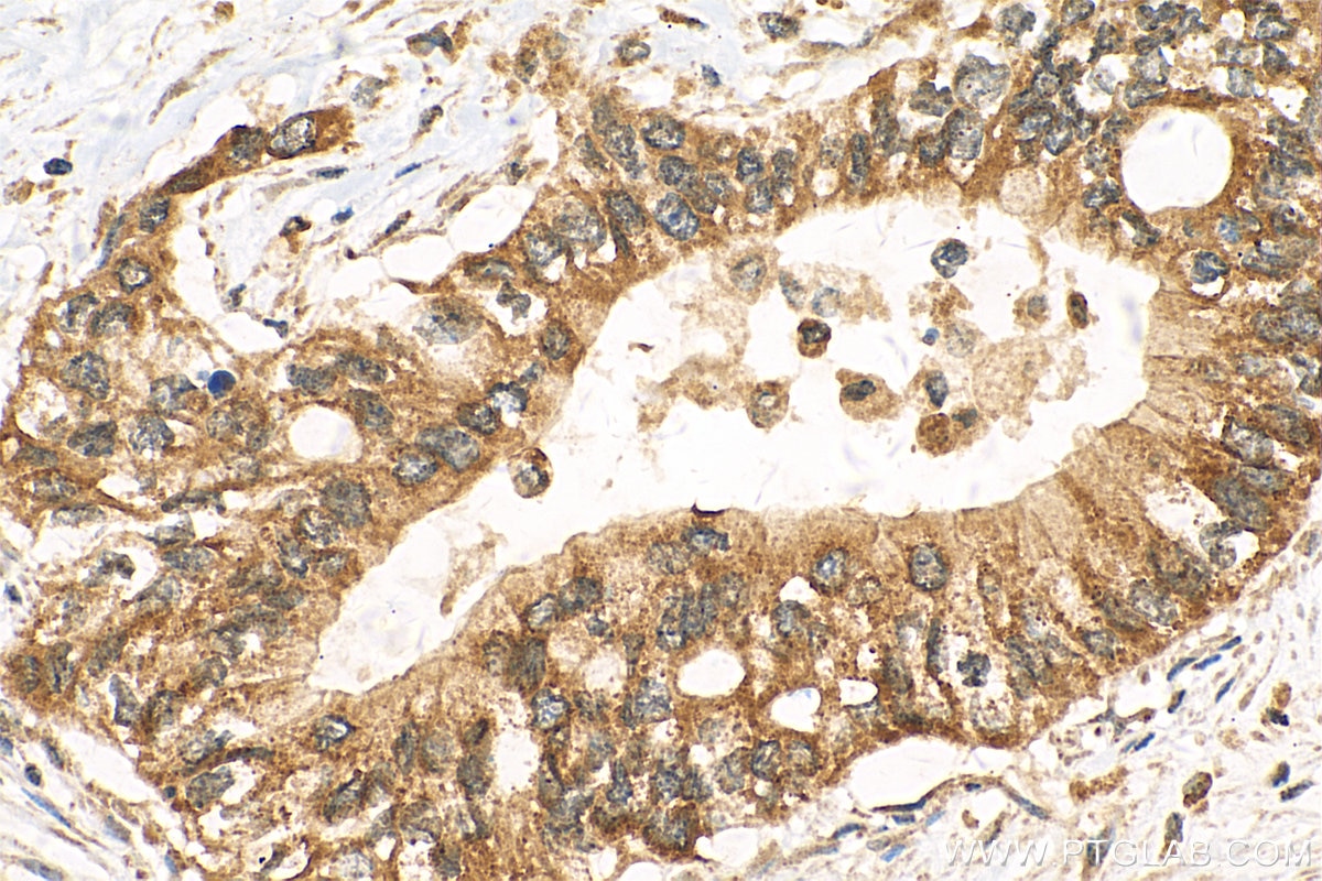 Immunohistochemistry (IHC) staining of human pancreas cancer tissue using IGF2BP2 Polyclonal antibody (11601-1-AP)