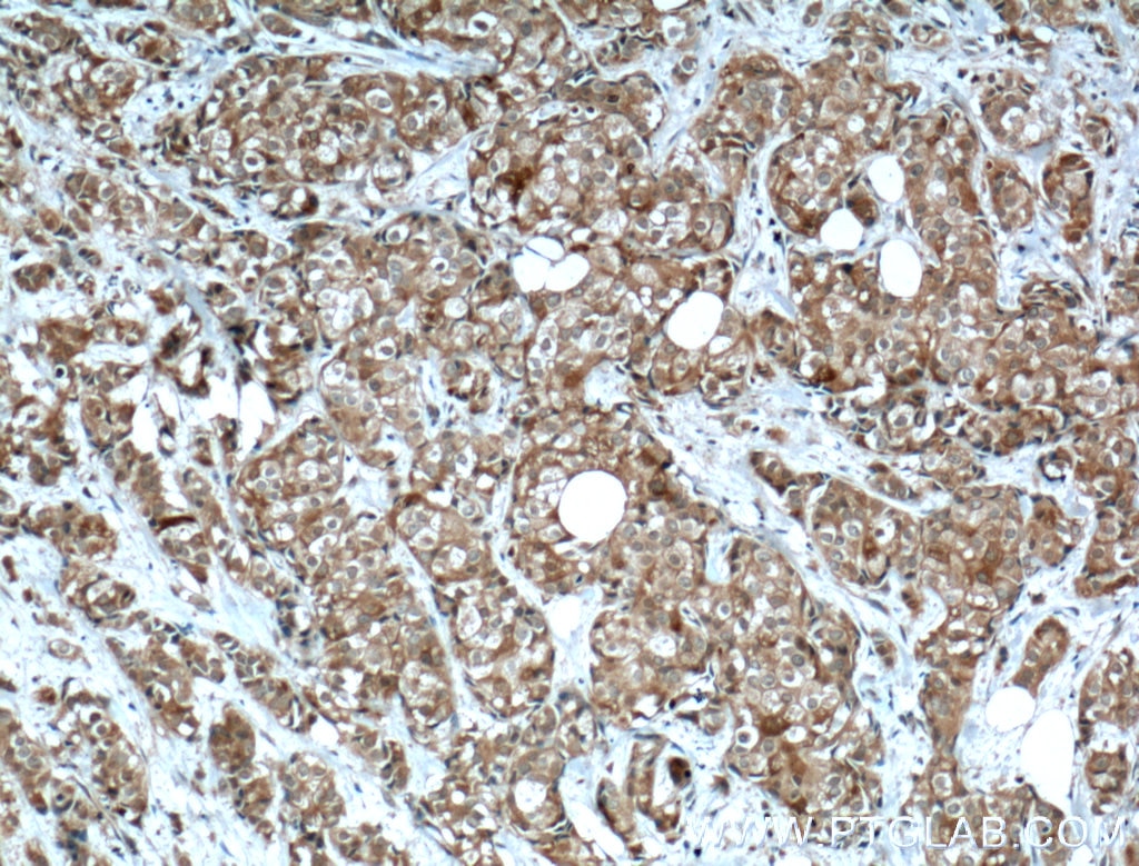 Immunohistochemistry (IHC) staining of human breast cancer tissue using IGF2BP2 Polyclonal antibody (11601-1-AP)