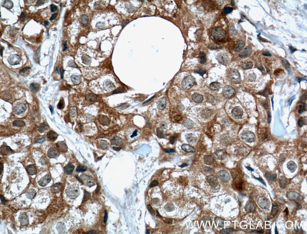 Immunohistochemistry (IHC) staining of human breast cancer tissue using IGF2BP2 Polyclonal antibody (11601-1-AP)