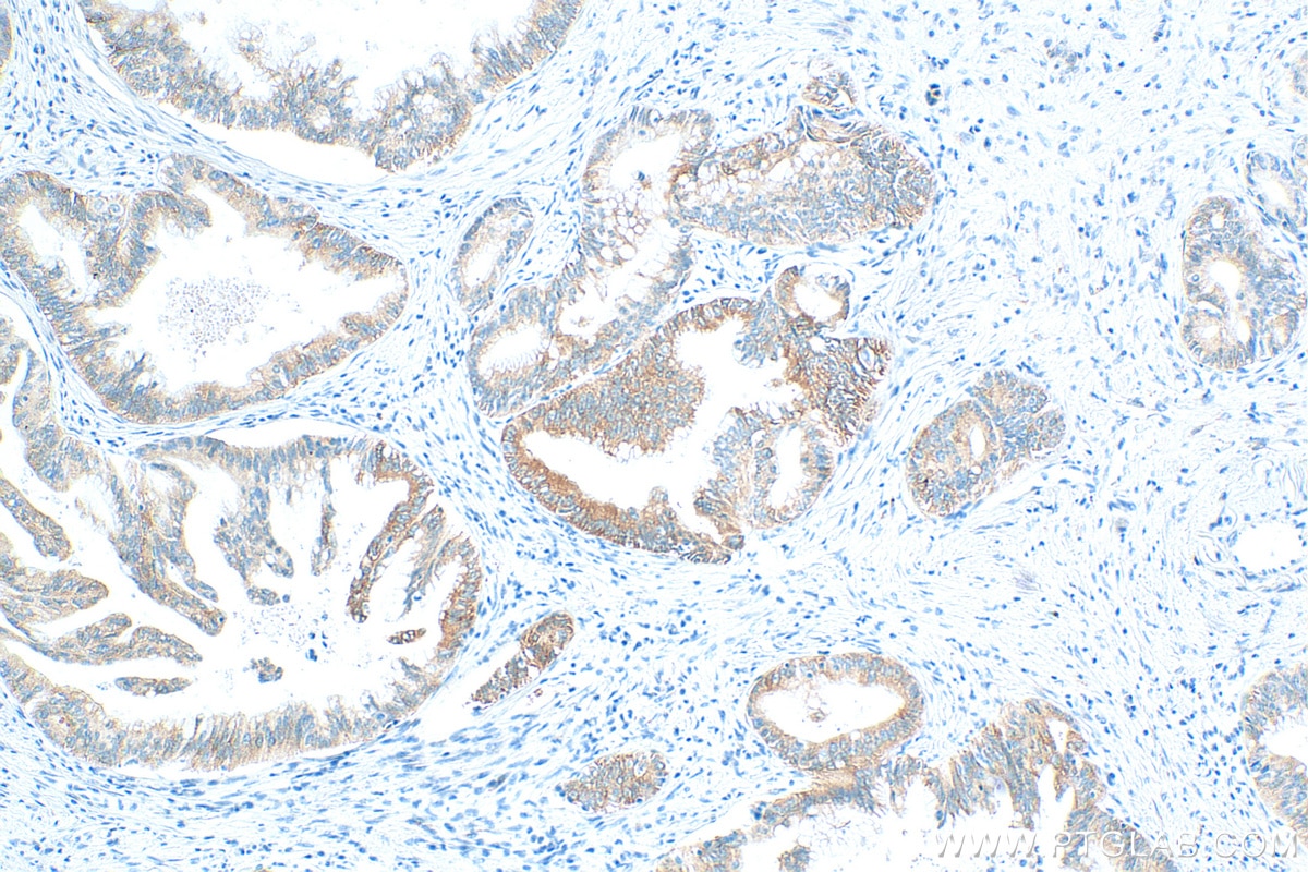 Immunohistochemistry (IHC) staining of human pancreas cancer tissue using IGF2BP2 Recombinant antibody (82757-2-RR)