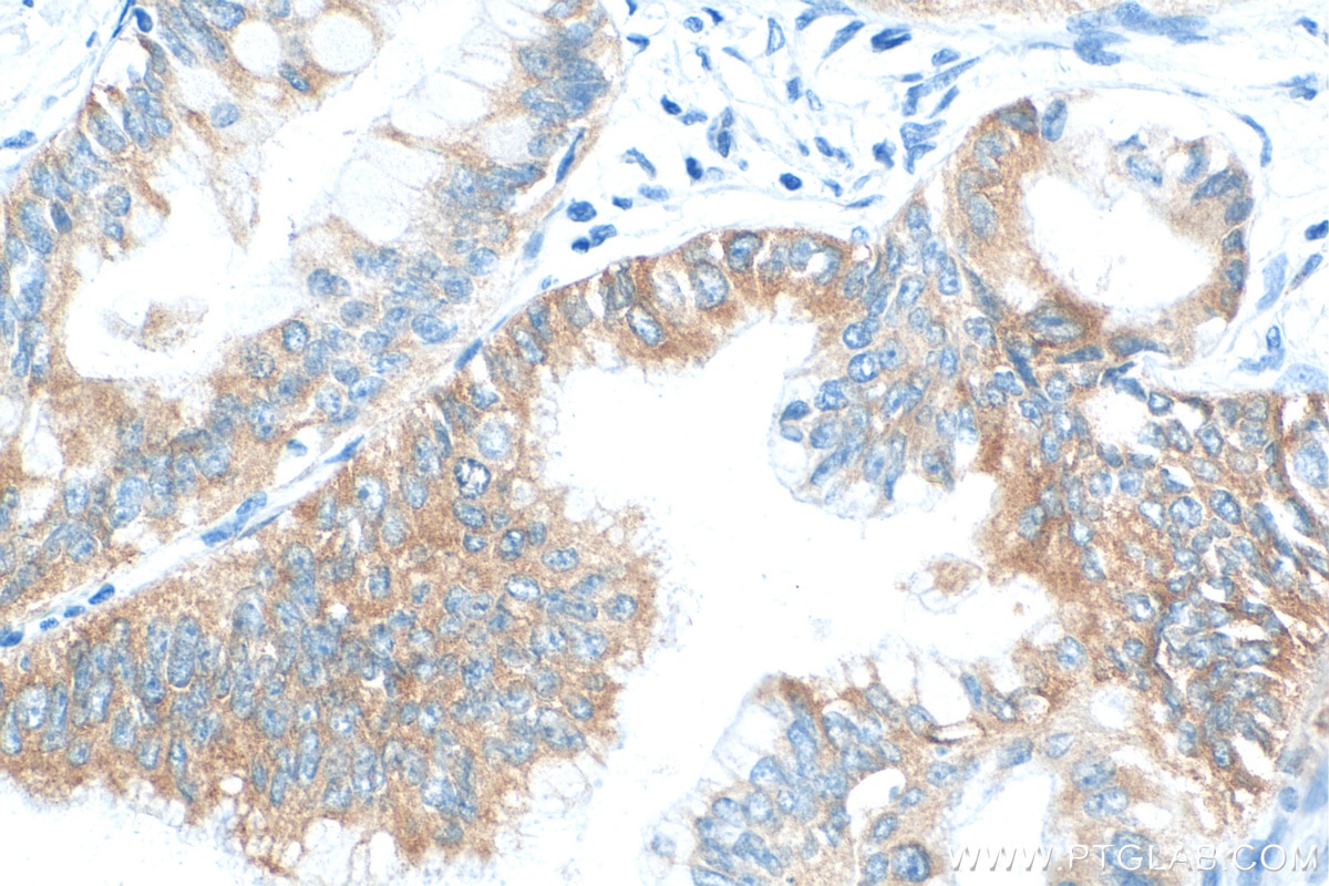 Immunohistochemistry (IHC) staining of human pancreas cancer tissue using IGF2BP2 Recombinant antibody (82757-2-RR)