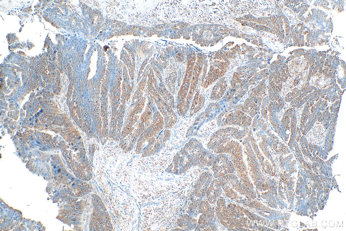 Immunohistochemical analysis of paraffin-embedded human colon cancer tissue slide using 14642-1-AP (IGF2BP3 antibody) at dilution of 1:1000 (under 10x lens). Heat mediated antigen retrieval with Tris-EDTA buffer (pH 9.0). Immunohistochemistry (IHC) staining of human colon cancer tissue using IGF2BP3 Polyclonal antibody (14642-1-AP)