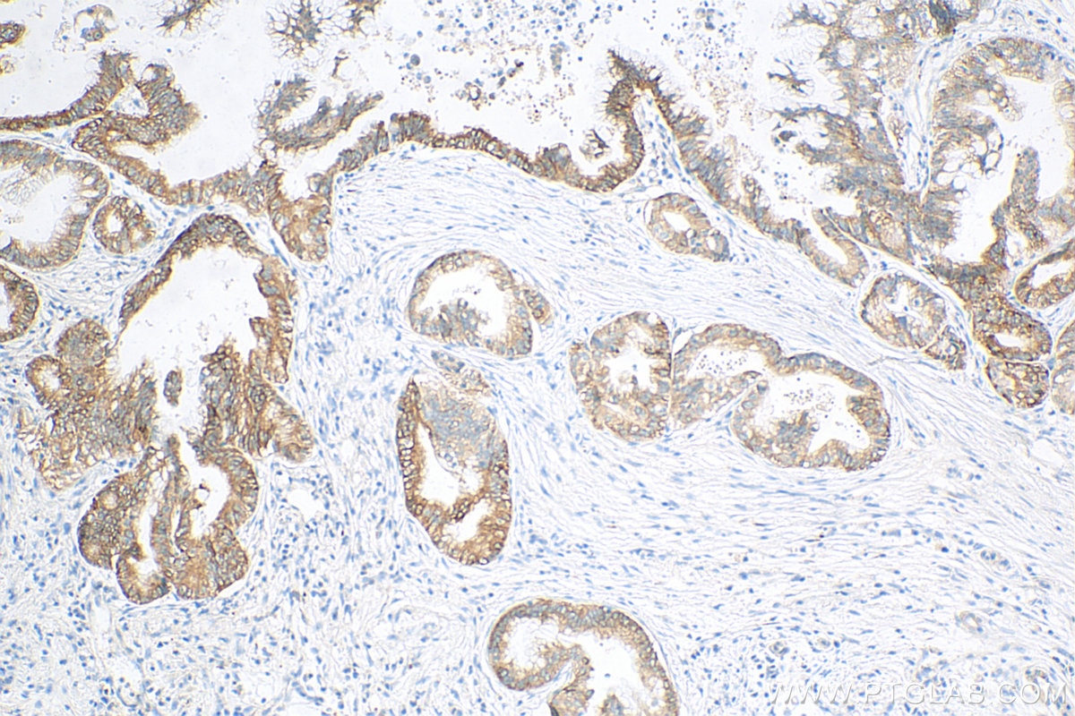 IHC staining of human pancreas cancer using 81805-1-RR