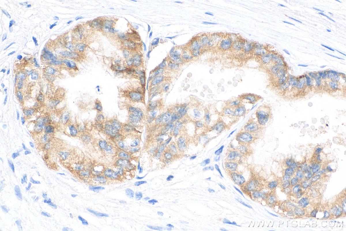 Immunohistochemistry (IHC) staining of human pancreas cancer tissue using IGF2BP3 Recombinant antibody (81805-1-RR)