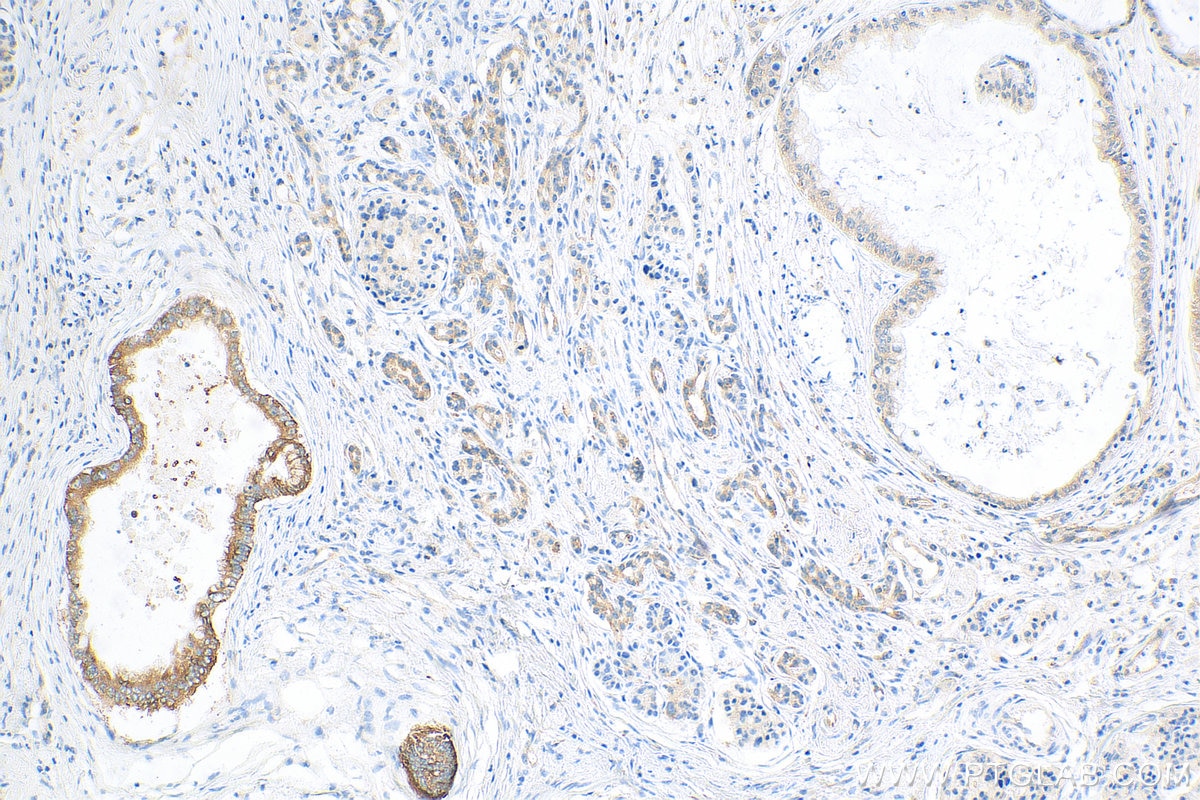 Immunohistochemistry (IHC) staining of human pancreas cancer tissue using IGF2BP3 Recombinant antibody (81805-1-RR)