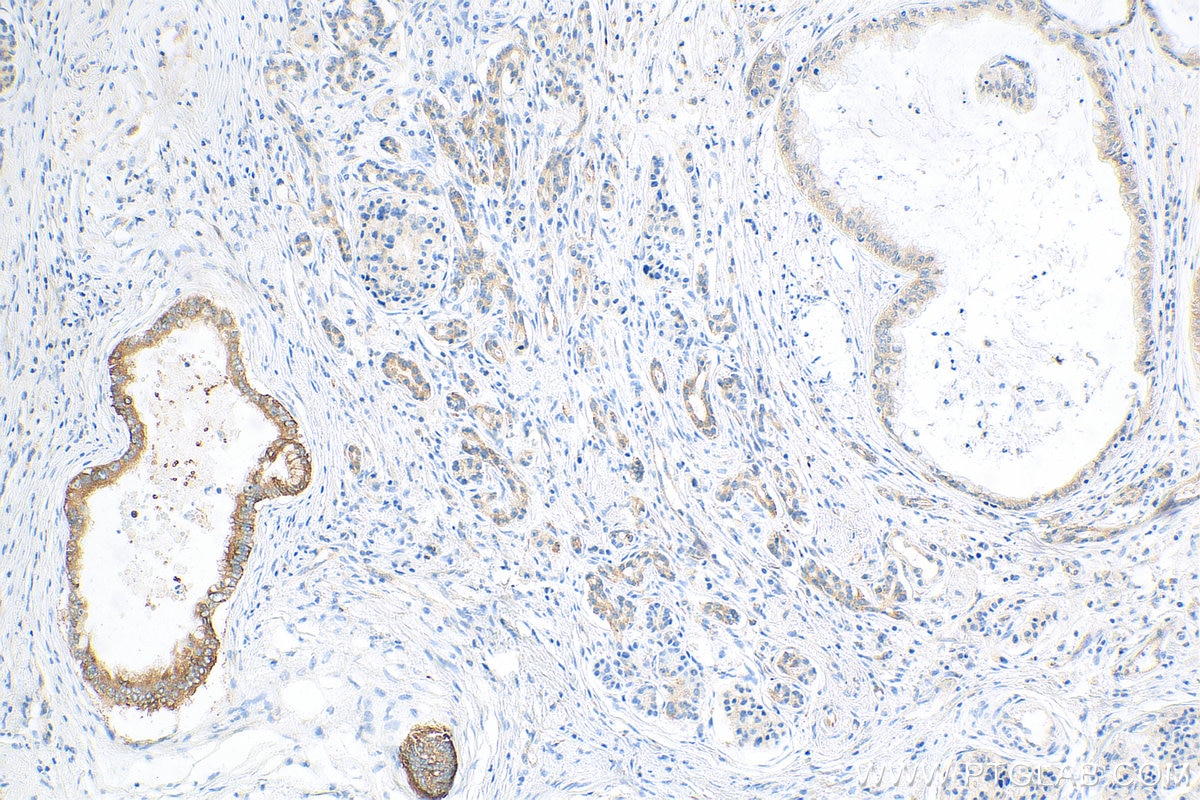 IHC staining of human pancreas cancer using 81805-1-RR