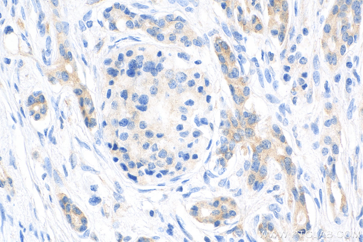 Immunohistochemistry (IHC) staining of human pancreas cancer tissue using IGF2BP3 Recombinant antibody (81805-1-RR)