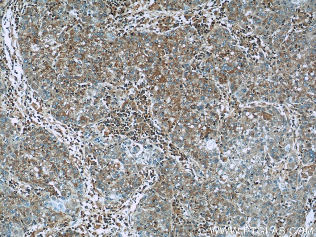 Immunohistochemistry (IHC) staining of human liver cancer tissue using IGF2R-Specific Polyclonal antibody (20253-1-AP)